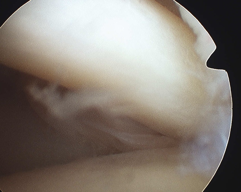 Arthroscopy Normal Biceps Tendon 